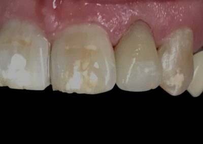 Chipped tooth repair from a patient at Rocky Creek Dental Care
