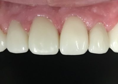 A fully cleaned and restored mouth from a patient at Rocky Creek Dental Care