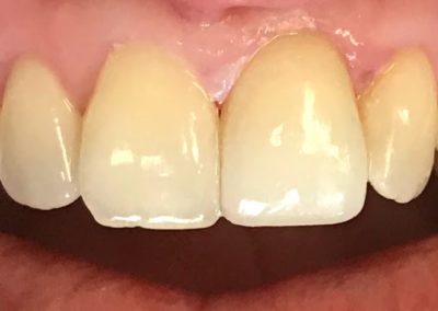 Fully restored mouth and gums of a patient at Rocky Creek Dental Care