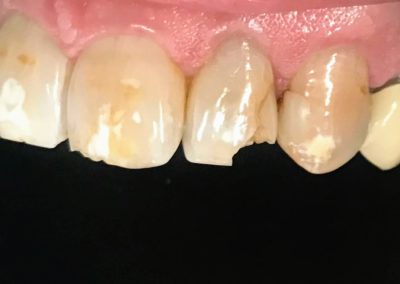A chipped front tooth and discolored teeth in the mouth of a patient at Rocky Creek Dental Care