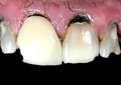 Severely decayed gums and broken, rotten teeth in the mouth of a patient at Rocky Creek Dental Care