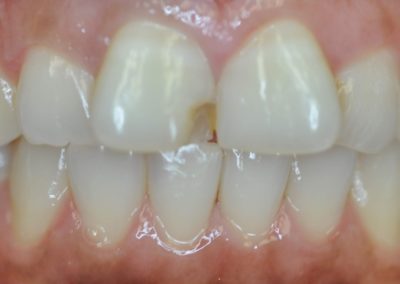 A chipped front tooth in the mouth of a patient at Rocky Creek Dental Care