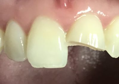 A broken front tooth in the mouth of a patient at Rocky Creek Dental Care
